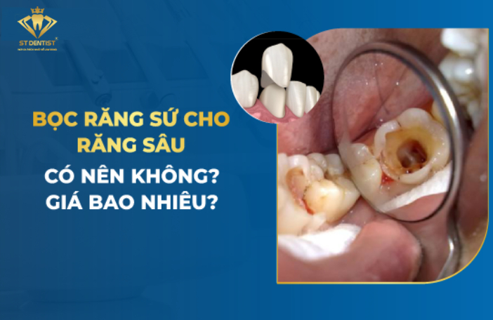 Bọc Răng Sứ Cho Răng Sâu Được Không【BS.Giải Đáp】