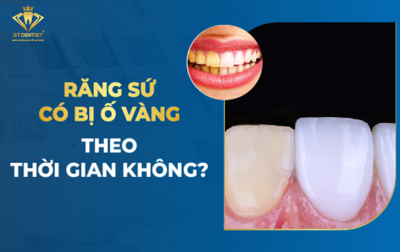 Bọc Răng Sứ Có Bị Xuống Màu Không? Cách Giúp Răng Sứ Luôn Trắng Sáng