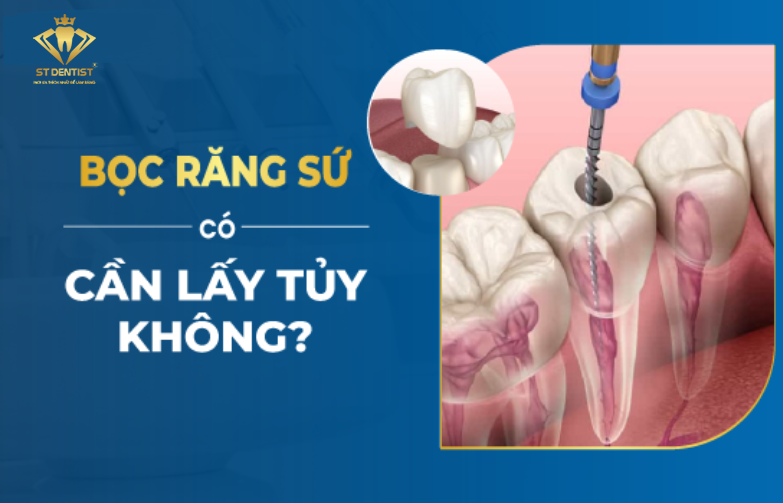 Bọc Răng Sứ Có Cần Lấy Tủy Không【BS.Chia Sẻ】