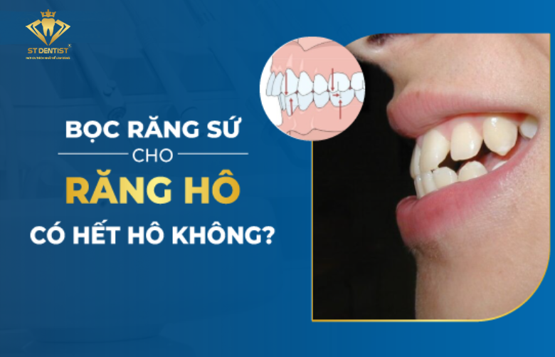 Bọc Răng Sứ Có Hết Hô Không【BS.Giải Đáp】