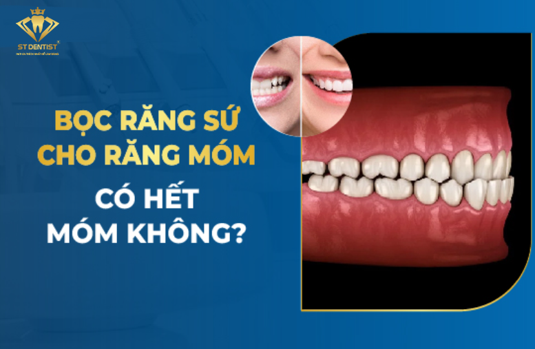 Bọc Răng Sứ Có Hết Móm Không【BS.Tư Vấn】