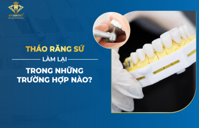 Bọc Răng Sứ Có Tháo Ra Được Không【BS.Tư Vấn】