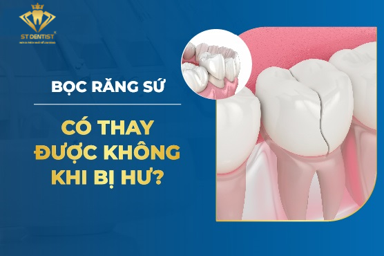 Bọc Răng Sứ Có Thay Được Không【BS.Tư Vấn】