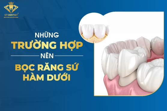 Bọc Răng Sứ Hàm Dưới - Những Điều Bạn Cần Biết