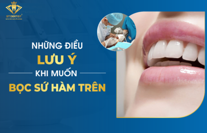 Bọc Răng Sứ Hàm Trên - Những Điều Cần Lưu Ý