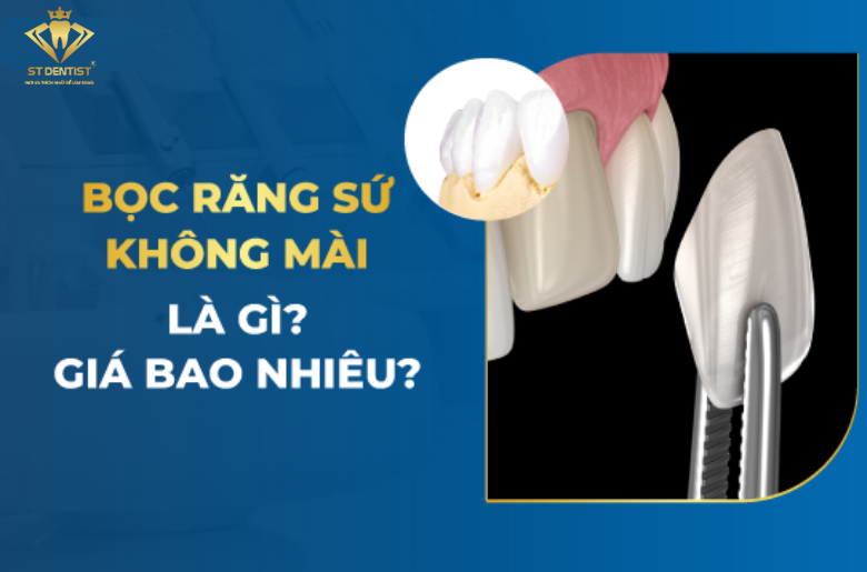 Bọc Răng Sứ Không Mài - Bảo Tồn Răng Thật