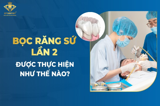 Bọc Răng Sứ Lần 2 Khi Nào Và Những Lưu Ý