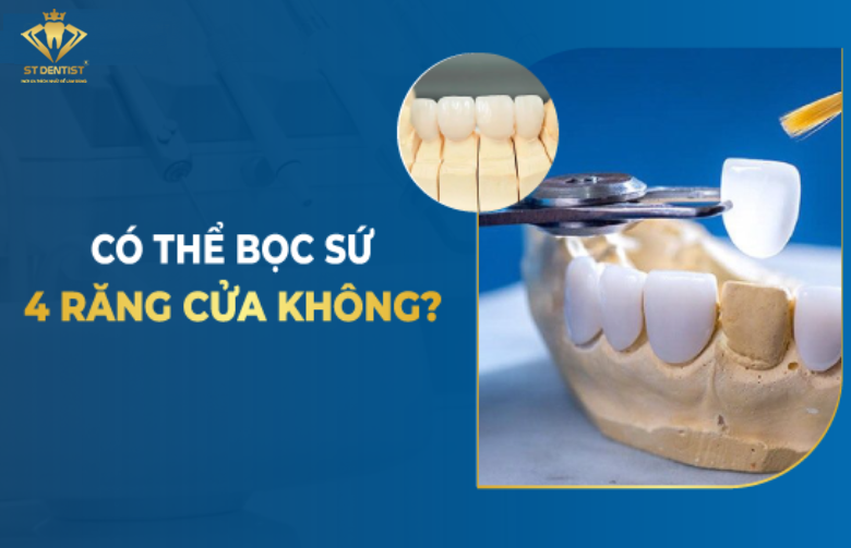 Bọc Sứ 4 Răng Cửa Được Không【BS.Giải Đáp】