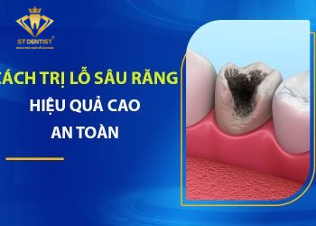 Cách Trị Lỗ Sâu Răng Hiệu Quả【BS.Tư Vấn】