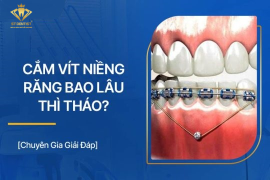 Cắm Vít Niềng Răng Bao Lâu Thì Tháo【BS.Tư Vấn】