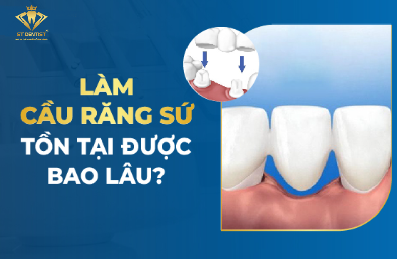 Làm Cầu Răng Sứ Tồn Tại Được Bao Lâu【BS.Tư Vấn】