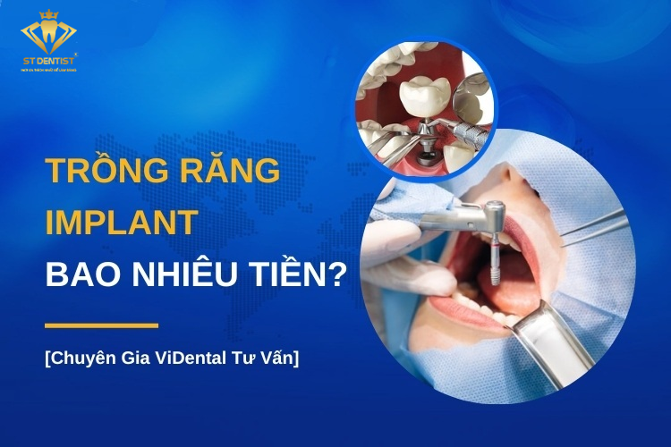 Cấy Ghép Răng Implant Mất Bao Nhiêu Tiền【Tìm Hiểu】