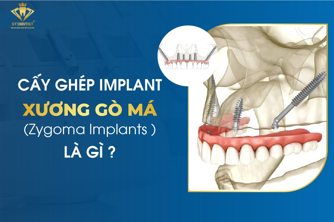 Tìm Hiểu Cấy Ghép Implant Xương Gò Má【Zygoma Implant】