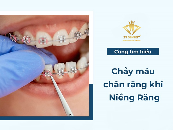 Bị Chảy Máu Chân Răng Khi Niềng Răng Có Sao Không【BS.Tư Vấn】