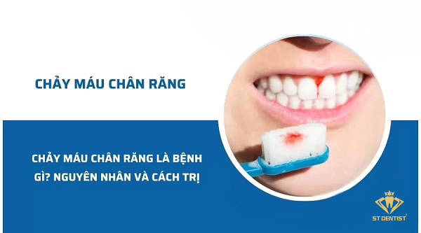 Chảy Máu Chân Răng Là Bệnh Gì? Nguyên Nhân Và Cách Điều Trị