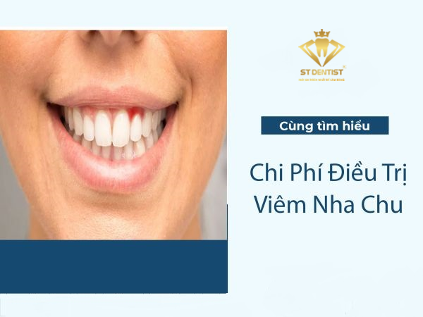 Chi Phí Điều Trị Viêm Nha Chu Mới Nhất【Tìm Hiểu】