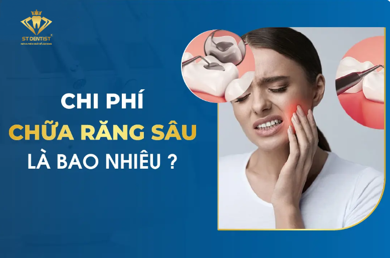 Chi Phí Điều Trị Sâu Răng: Những Điều Bạn Cần Biết