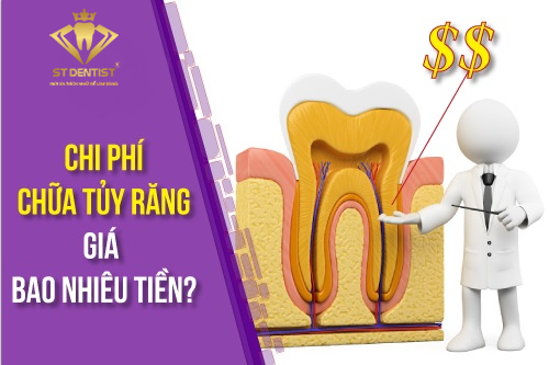 Chi Phí Điều Trị Tủy Răng: Tìm Hiểu Và Cách Tiết Kiệm Chi Phí