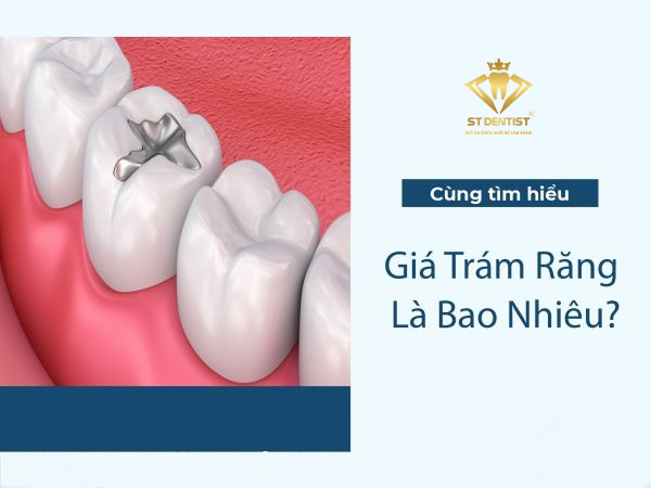 Chi Phí Trám Răng Bao Nhiêu Tiền? Cập Nhật Bảng Giá Mới Nhất