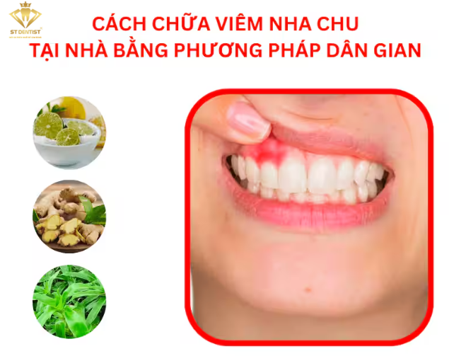 Mẹo Chữa Viêm Nha Chu Bằng Phương Pháp Dân Gian Hiệu Quả Và An Toàn