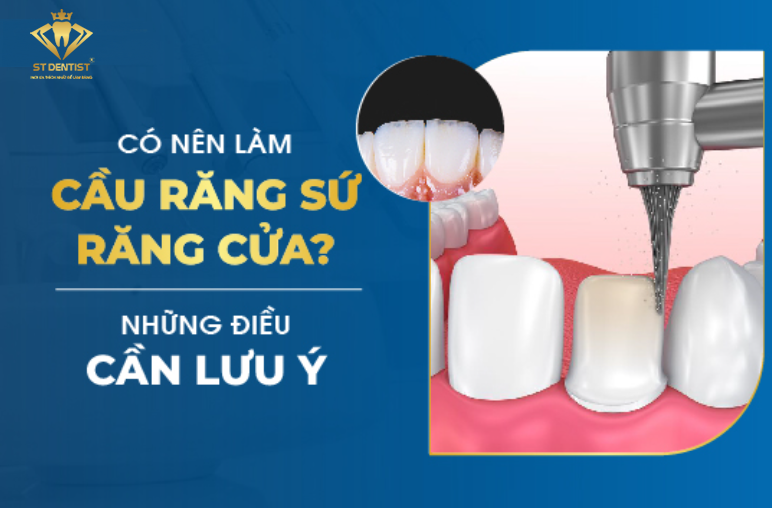 Có Nên Làm Cầu Răng Sứ Răng Cửa Không【BS.Tư Vấn】