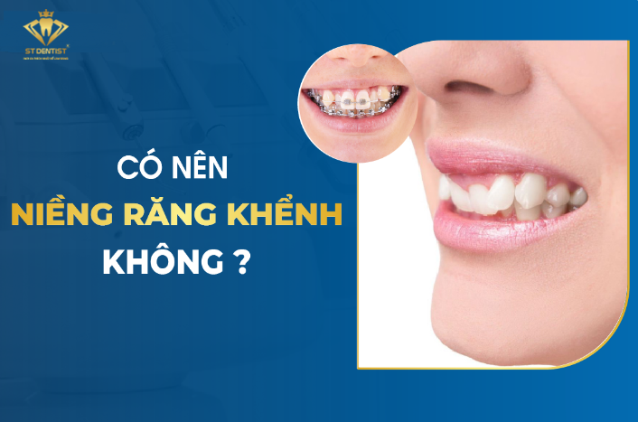 Có Nên Niềng Răng Khểnh Không【Tìm Hiểu】