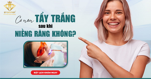 Có Nên Tẩy Trắng Răng Sau Khi Niềng Không【Tìm Hiểu】