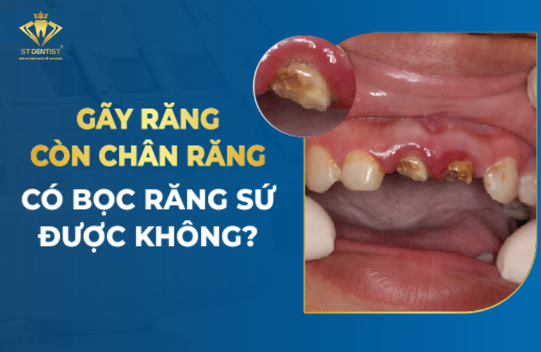 Còn Chân Răng Có Bọc Răng Sứ Được Không【BS.Giải Đáp】