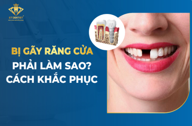 Bị Gãy Răng Cửa Phải Làm Sao【BS.Giải Đáp】