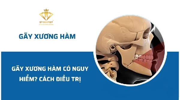 Gãy Xương Hàm Có Nguy Hiểm Không【BS.Giải Đáp】