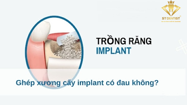 Ghép Xương Trong Cấy Implant Có Đau Không【BS.Giải Đáp】