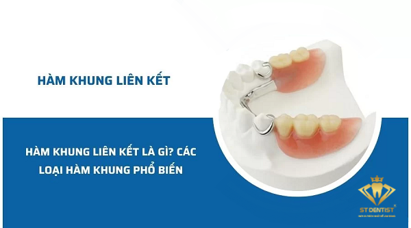 Hàm Khung Liên Kết Là Gì? Các Loại Hàm Khung Thường Dùng