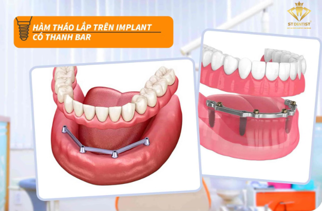 ham-thao-lap-tren-implant-co-thanh-bar