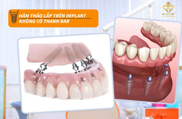 ham-thao-lap-tren-implant-khong-thanh-bar