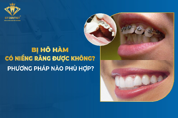 Hô Hàm Có Niềng Răng Được Không【BS.Tư Vấn】