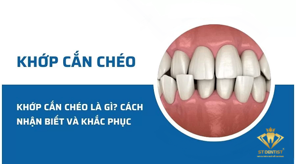 Khớp Cắn Chéo Là Gì? Cách Khắc Phục Thế Nào