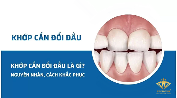 Khớp Cắn Đối Đầu Là Gì? Nguyên Nhân Và Cách Khắc Phục