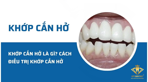 Khớp Cắn Hở Là Gì? Nguyên Nhân Và Cách Điều Trị