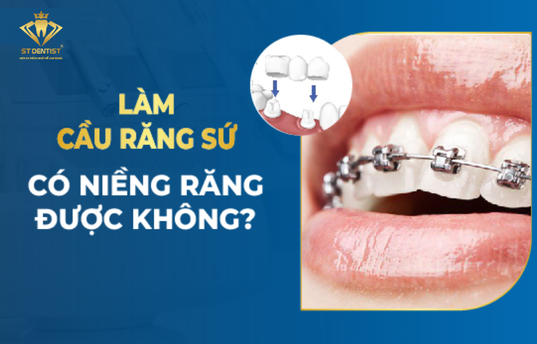 Làm Cầu Răng Sứ Có Niềng Răng Được Không【BS.Tư Vấn】