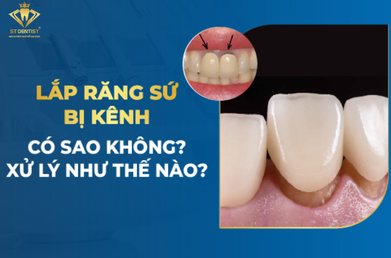 Lắp Răng Sứ Bị Kênh Có Sao Không【BS.Tư Vấn】