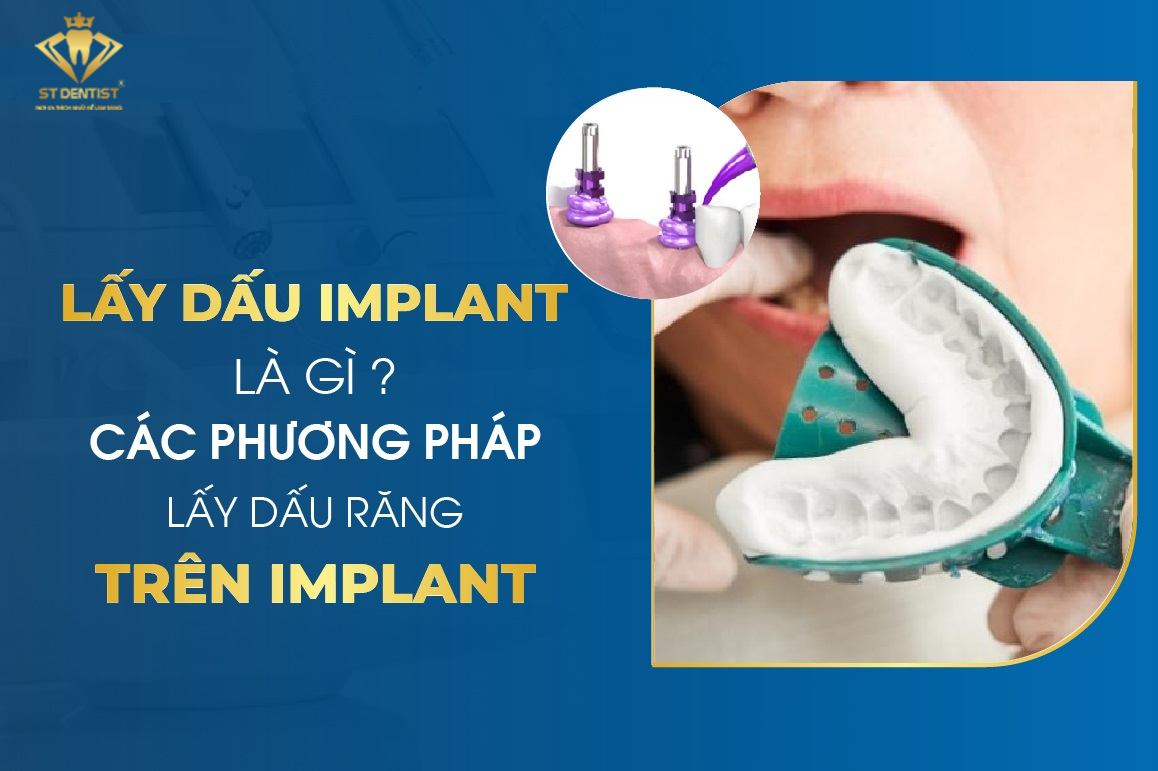 Lấy Dấu Implant Là Gì? Quy Trình Và Cách Thực Hiện