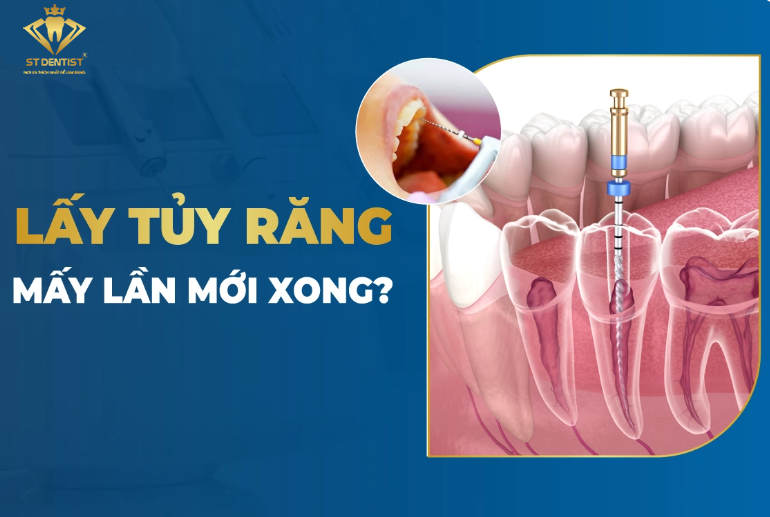 Lấy Tủy Răng Mấy Lần Mới Xong【BS.Tư Vấn】