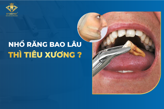 Mất Răng Bao Lâu Thì Bị Tiêu Xương Hàm【BS.Giải Đáp】