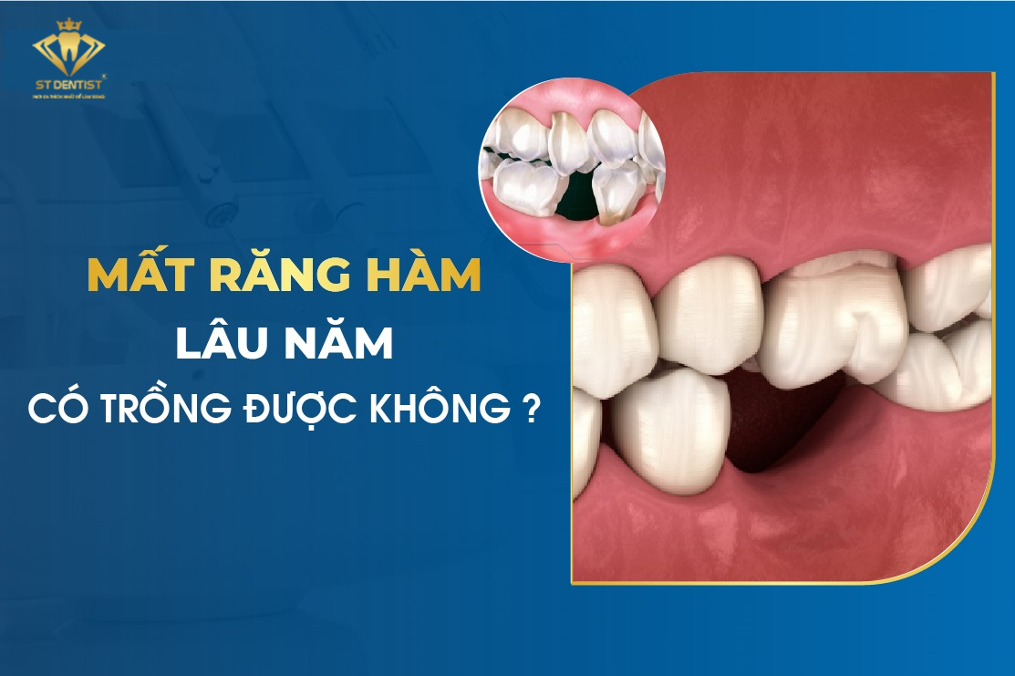 Mất Răng Lâu Năm Có Trồng Được Không【BS.Tư Vấn】