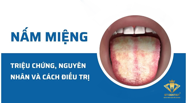 Nấm Miệng: Nhận Biết Dấu Hiệu Và Cách Điều Trị