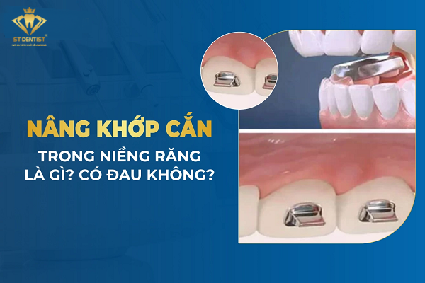 Nâng Khớp Cắn Trong Niềng Răng Có Tác Dụng Gì【Tìm Hiểu】