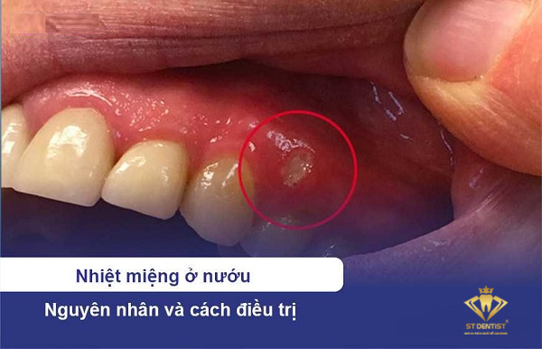 Nhiệt Miệng Ở Nướu: Nguyên Nhân Và Cách Điều Trị