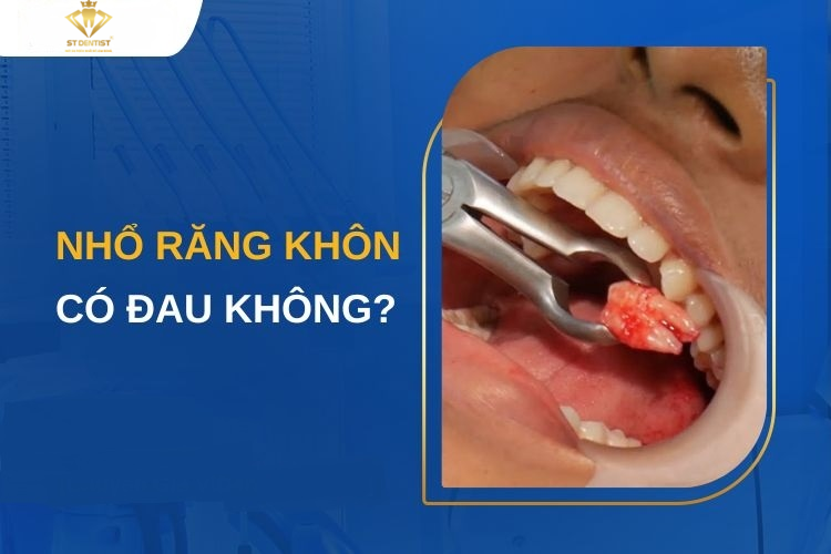 Nhổ Răng Khôn Có Đau Không? Những Điều Bạn Cần Biết