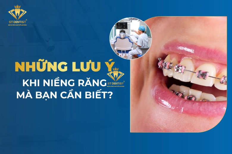 Những Lưu Ý Khi Niềng Răng【Bạn Cần Biết】