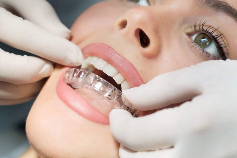 Niềng Răng Trong Suốt Invisalign và Invi’s Tại Nha Khoa ST Dentist